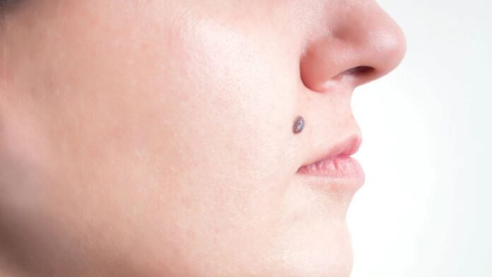 नाक के नीचे तिल